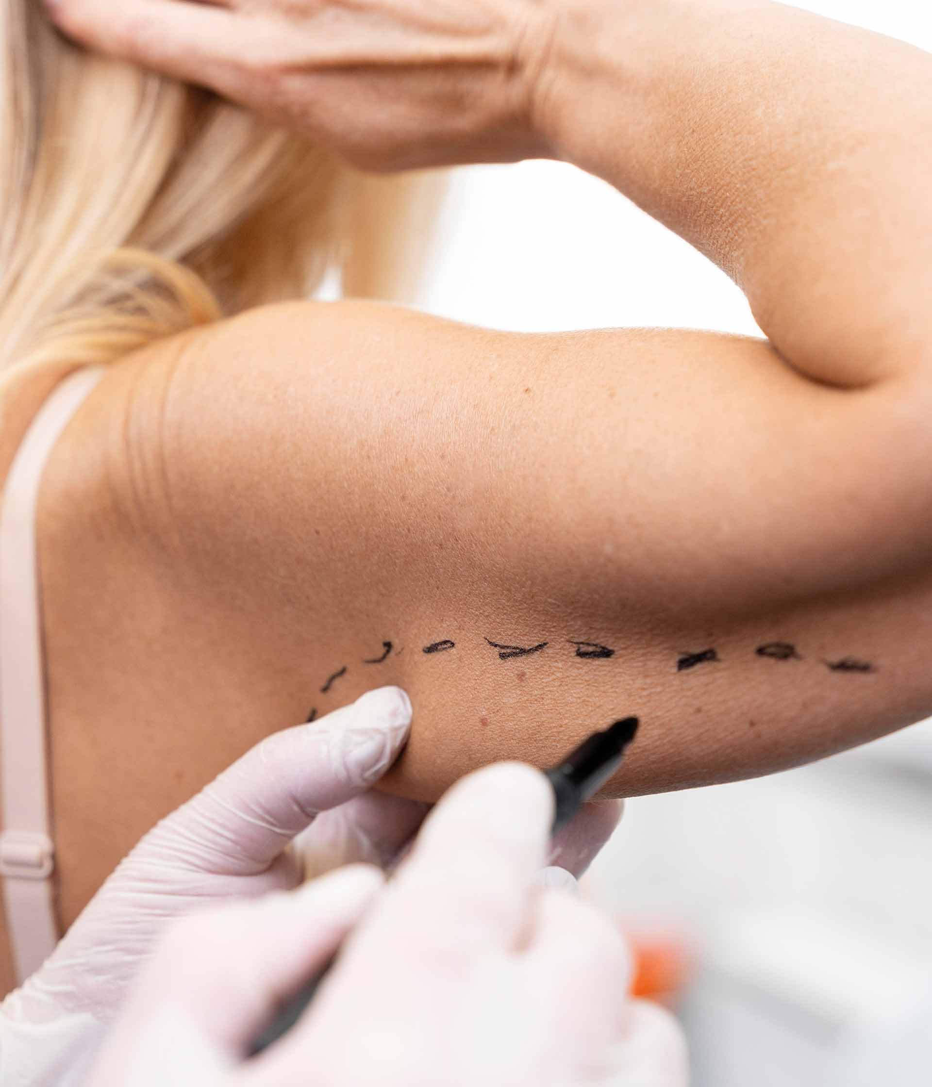 Braquioplastia o estiramiento de brazos